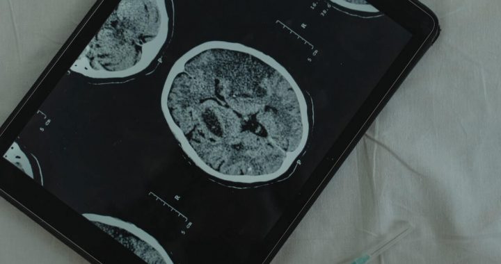 MRI מוח