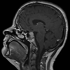 MRI מוח