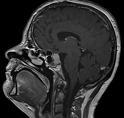MRI מוח